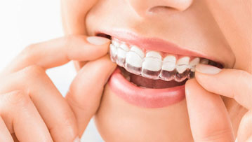 Περί aligners..