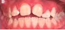 tooth child1